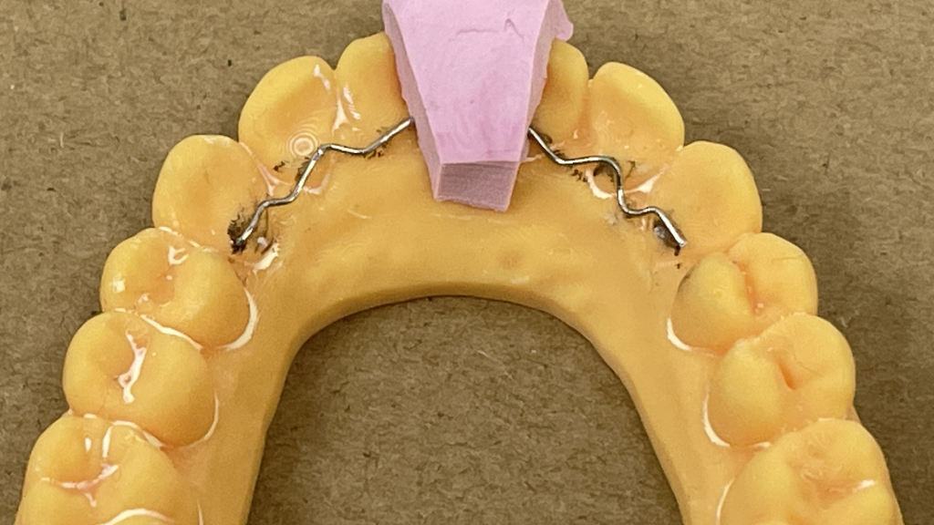 Orthodontic Retainers Riverina Dental Albury