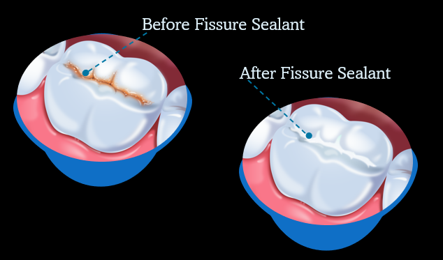 Brilliant Fissure Sealants
