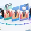 A Dental Implant Treatment Journey Example