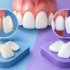 Composite Veneers Versus Porcelain Veneers