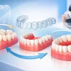 What Invisalign Results for Crowded Teeth Look Like